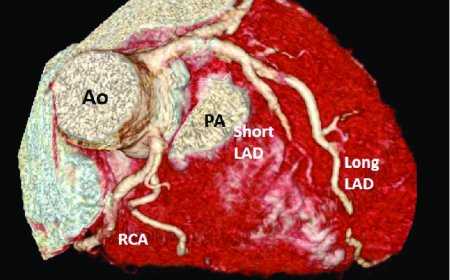 Cerrahi olarak revaskülarize edilmiş çift LAD