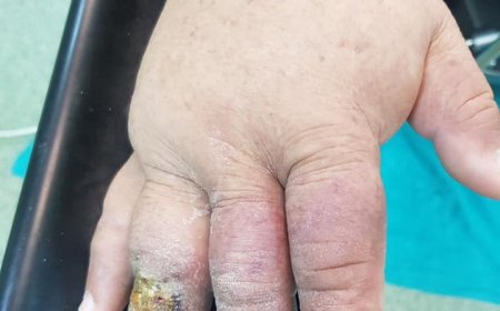 BRAKİAL FİSTÜLE BAĞLI STEAL-ÇALMA SENDROMU