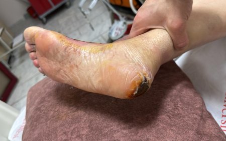 DİABETİK AYAK YARASI